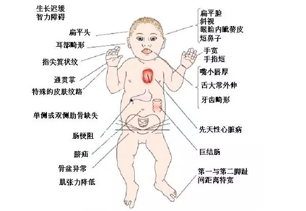 唐氏综合征是什么病?