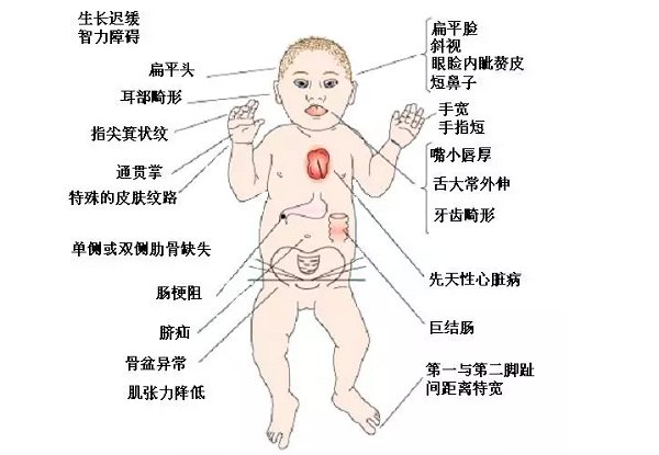 唐氏综合征是什么病？